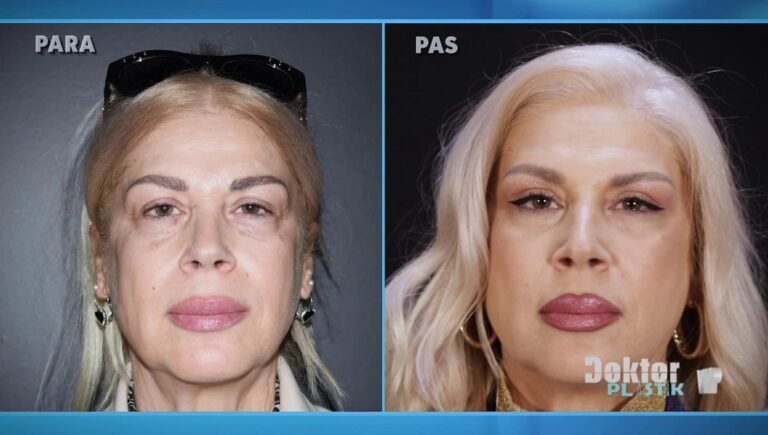 Belfaroplastike Siperore